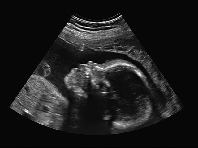 feto 4 mesi