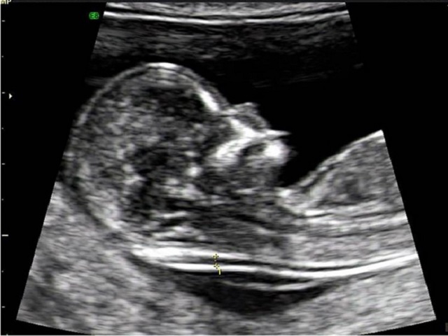 foto feto 14 settimane