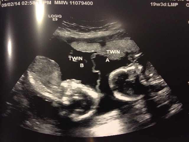 24 settimane di gravidanza gemellare