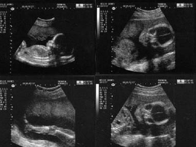 feto 22 settimane
