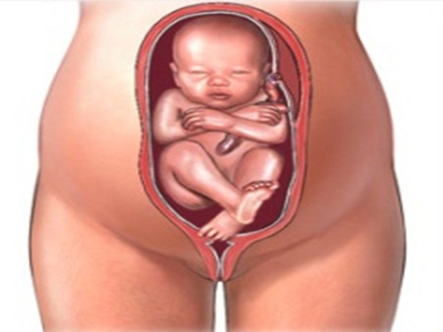 feto podalico a 36 settimane 